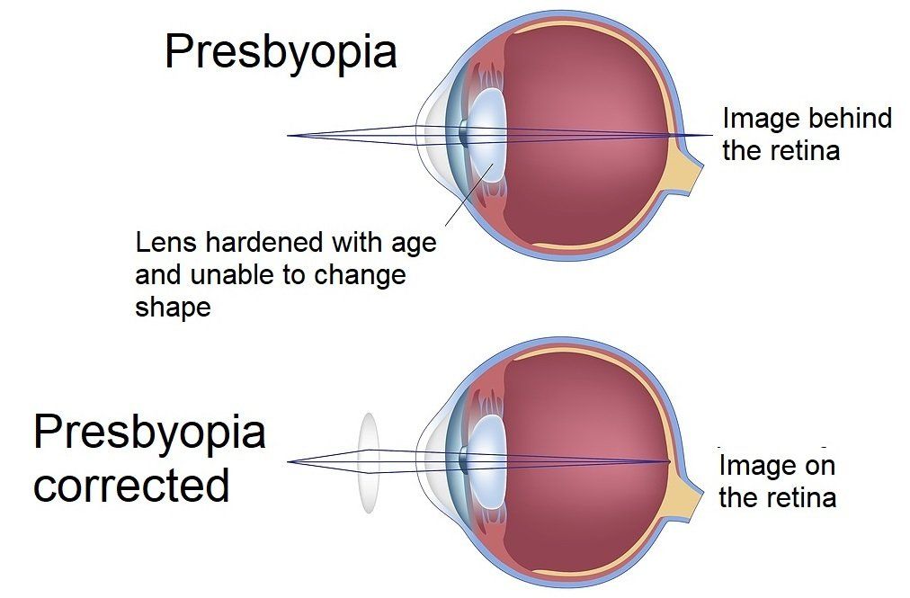 Presbyopia Presbyopia
