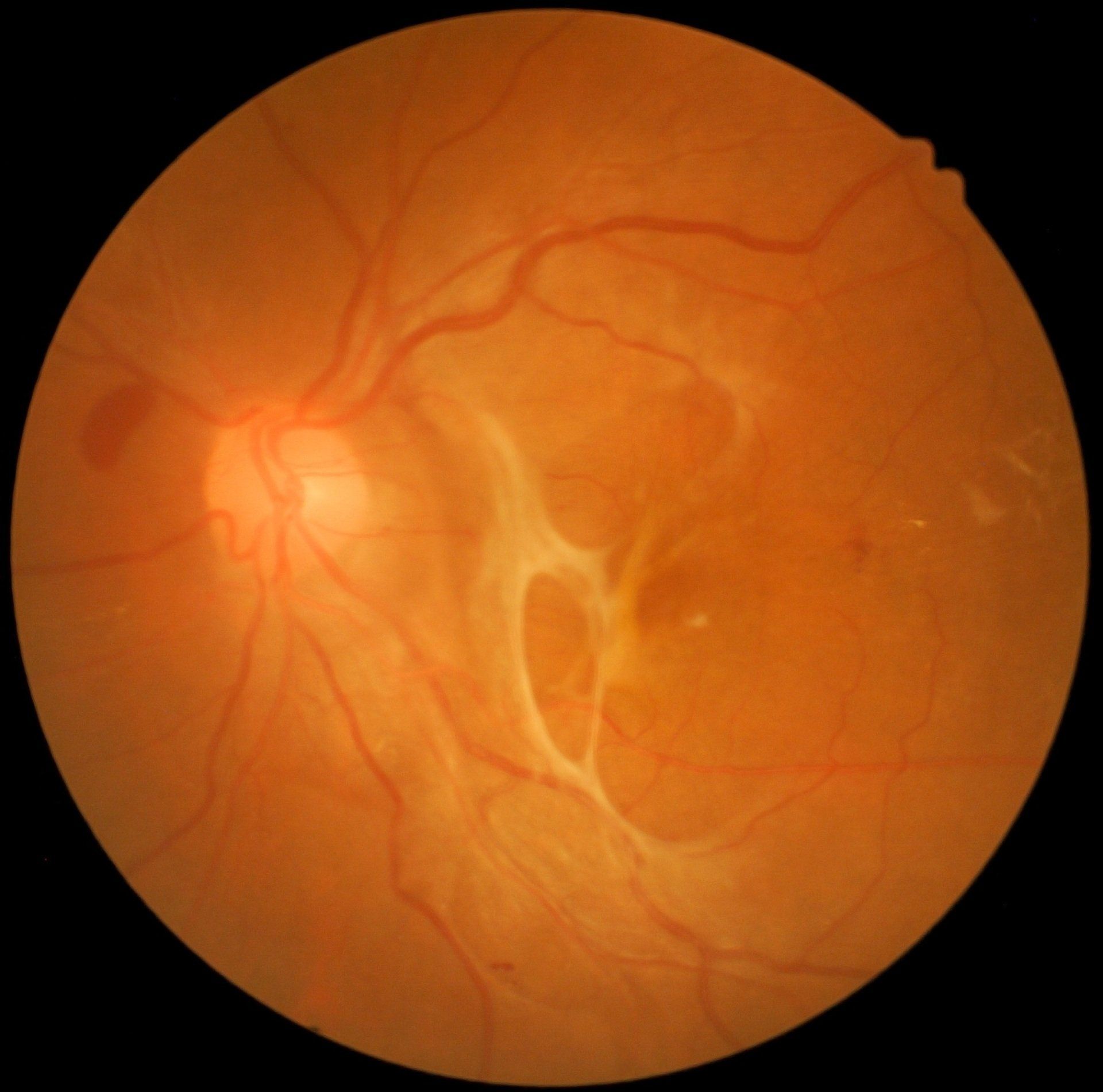 Tractional retinal detachment