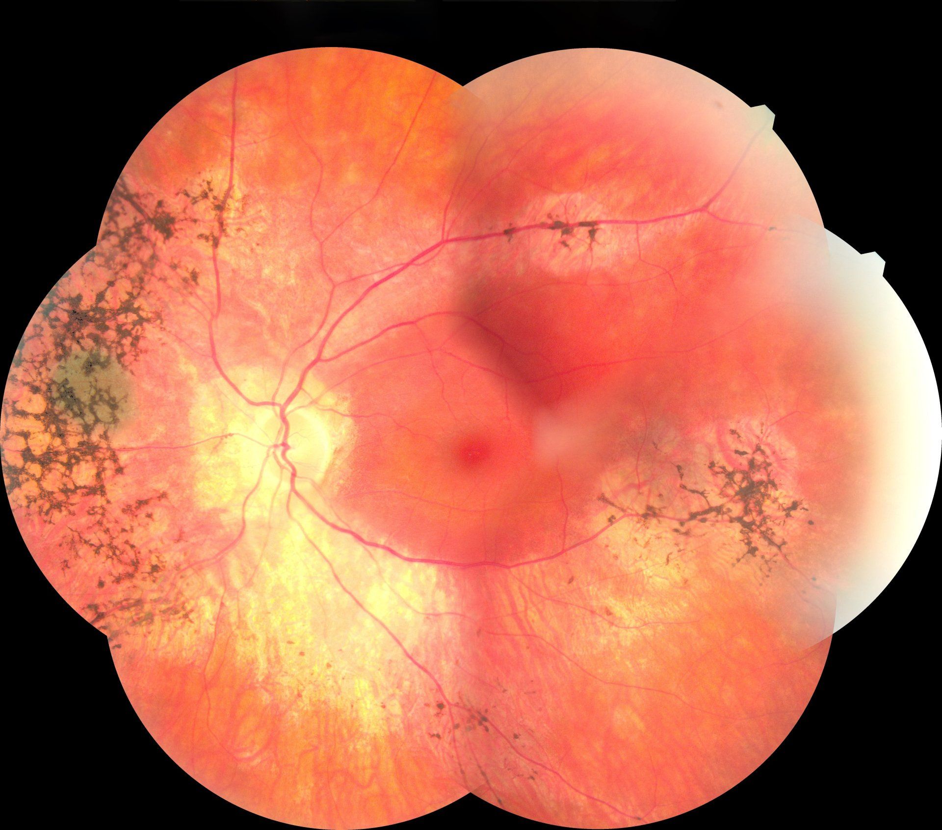 Retinitis Pigmentosa