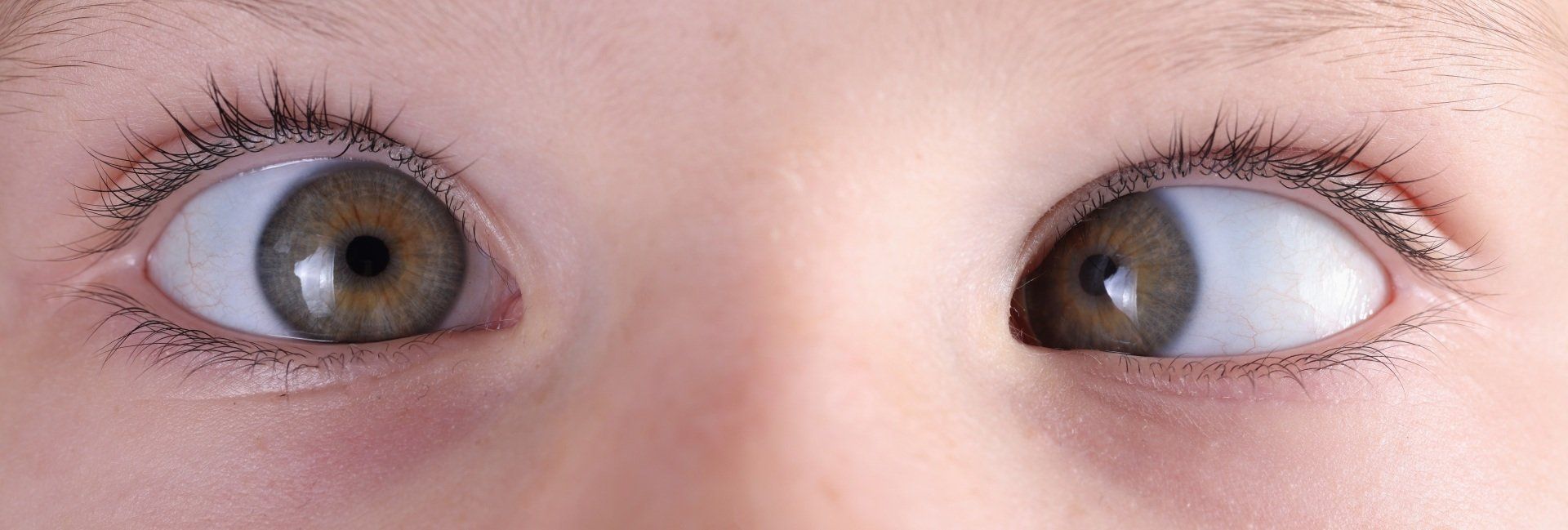 Strabismus