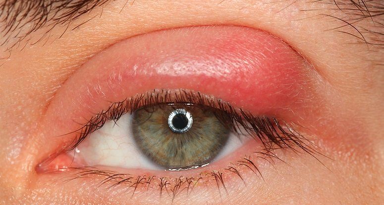 Stye or Internal Hordeolum