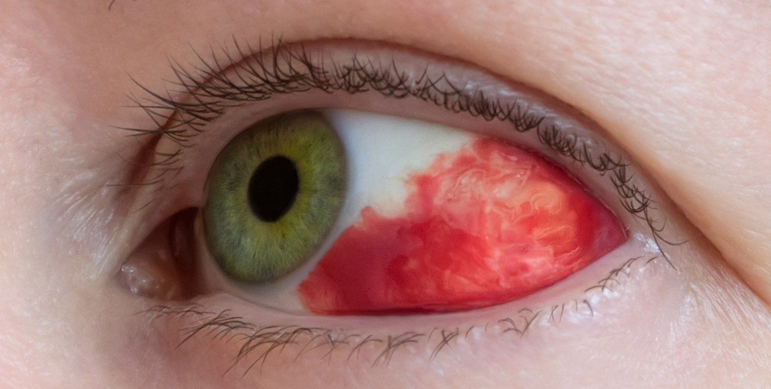 Subconjunctival Hemorrhage