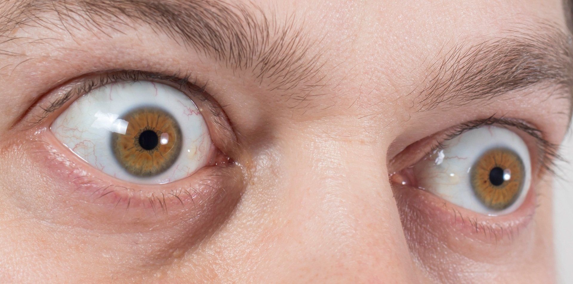 Exophthalmos in thyroid eye disease