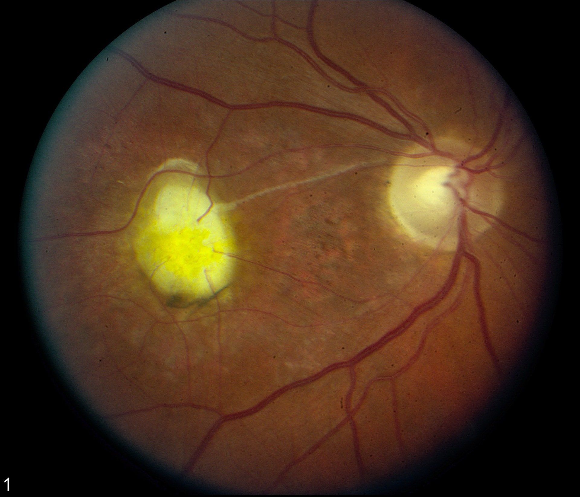 Ocular Toxoplasmosis