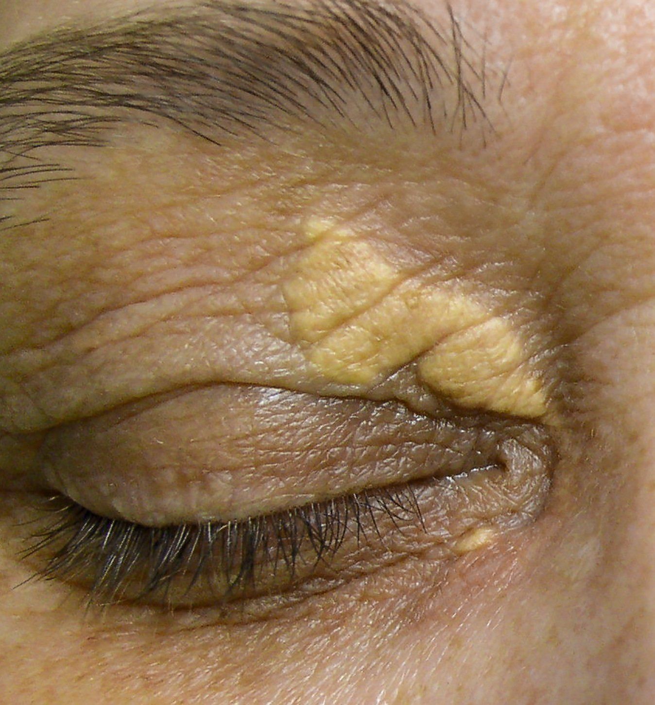 Xanthelasma