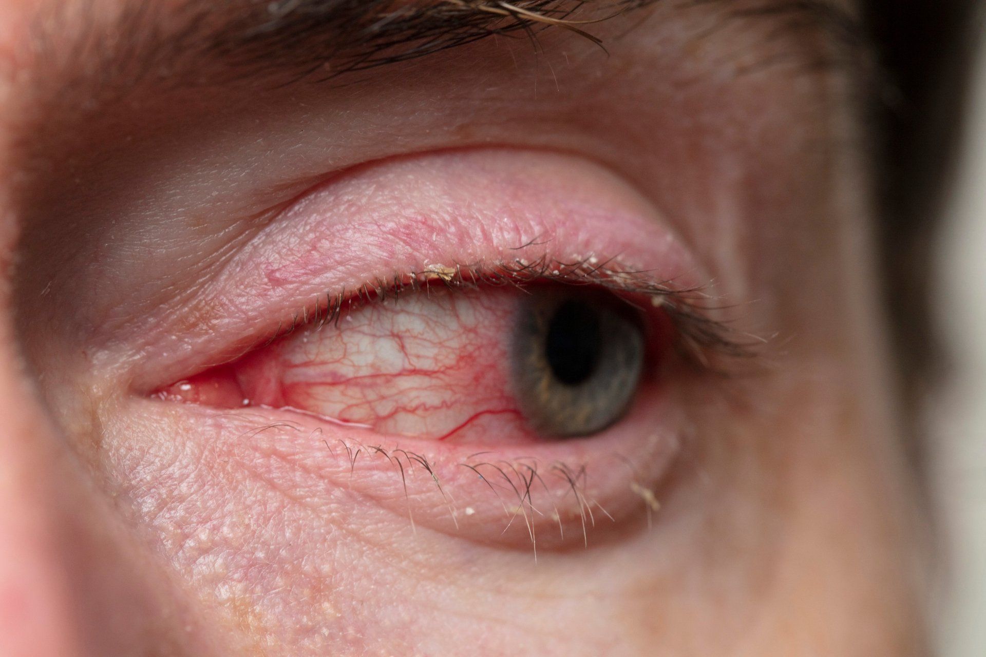 Blepharitis