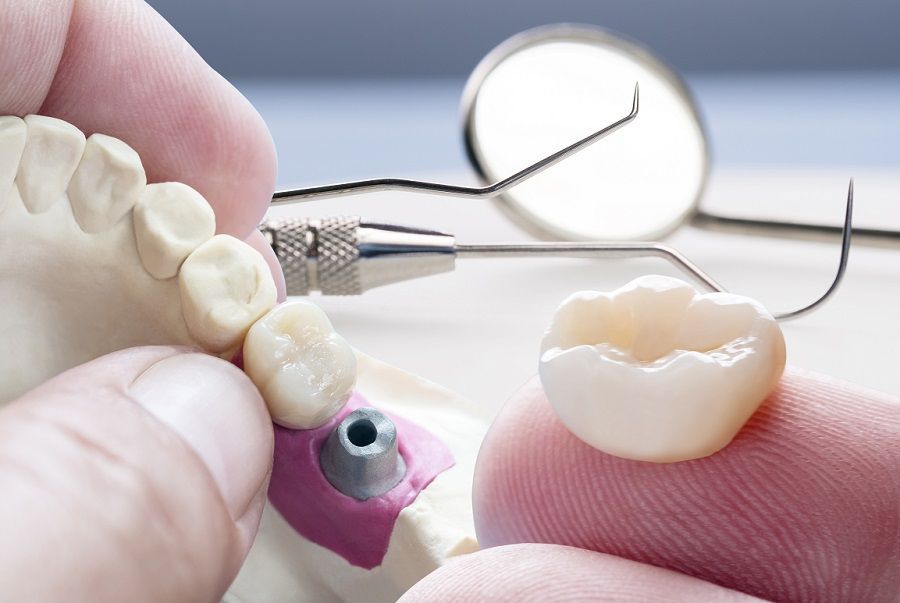 Dental implant being fitted into a gum model with a crown and dental tools nearby