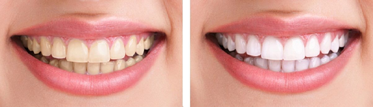 Side-by-side close-up of a smile with yellowed teeth and a brighter white-toothed smile