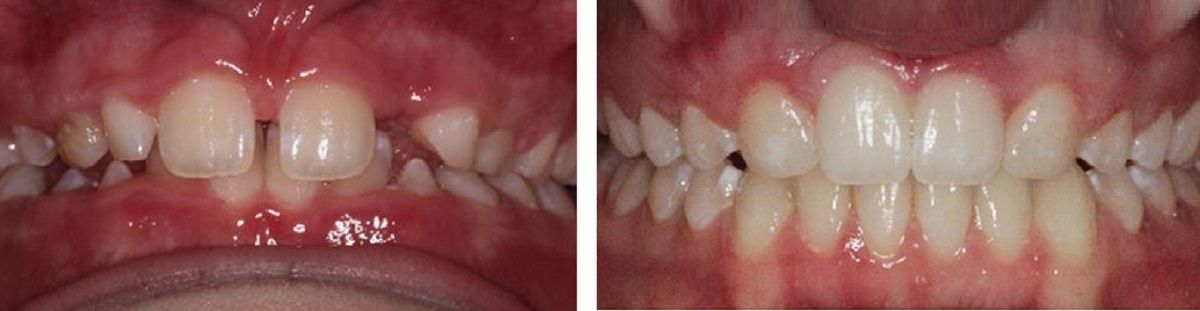 Close-up of teeth before and after braces, showing improved alignment