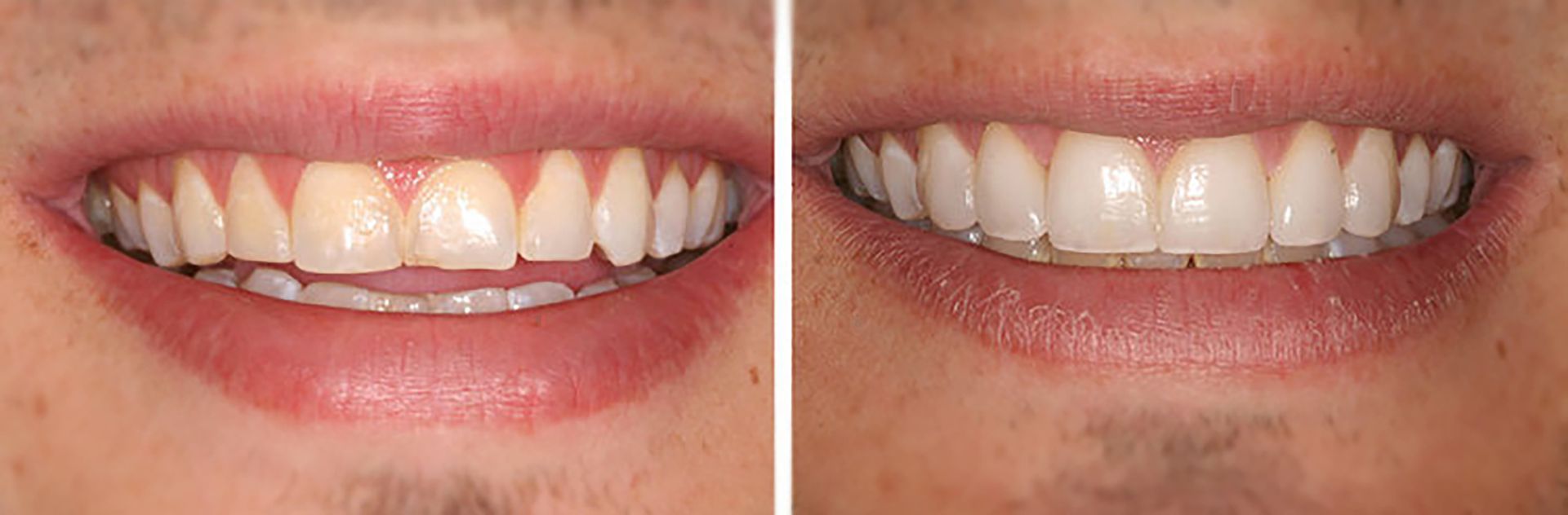 Side-by-side close-up of a smiling mouth before and after teeth whitening treatment.