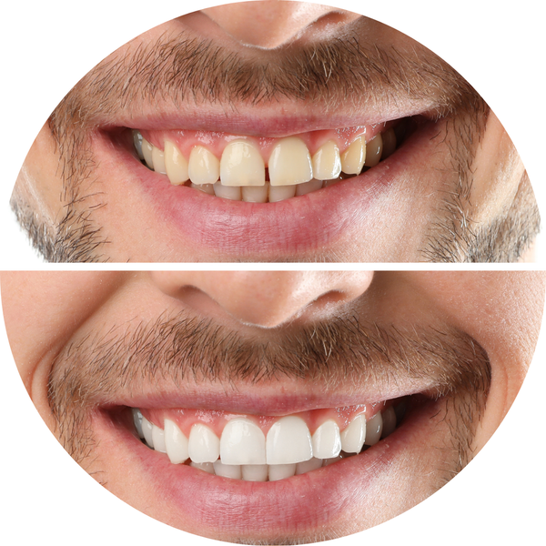 Side-by-side close-up of a smiling mouth before and after teeth whitening