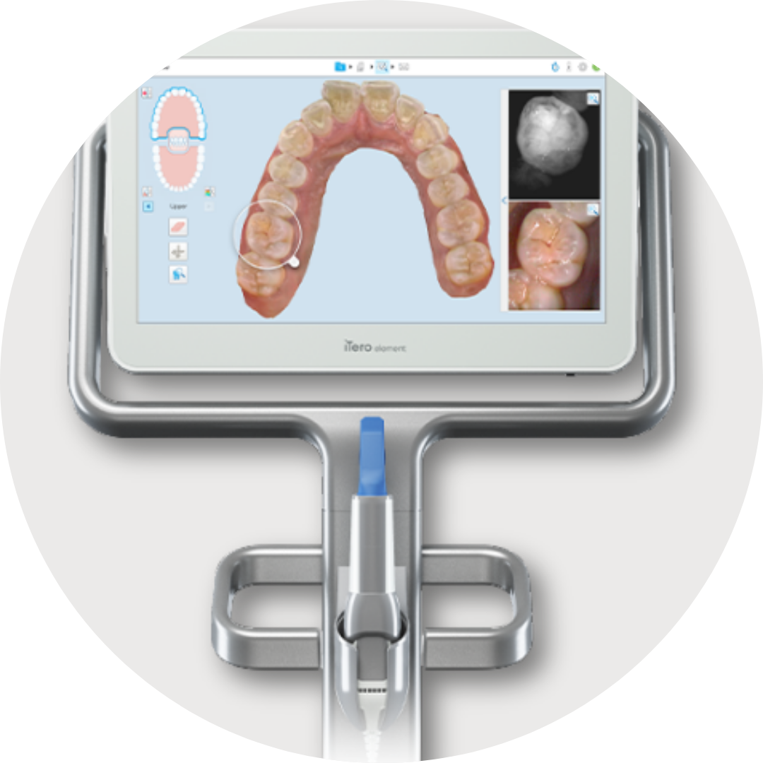 iTero digital dental scanner displaying a three-dimensional image of teeth at Vacca Family Dentistry