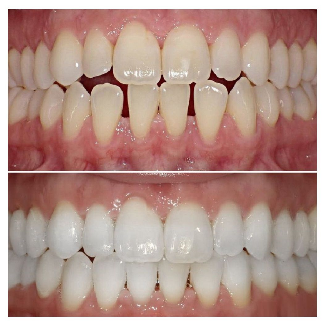 Before-and-after close-up of teeth alignment and whitening, showing improved straightness and brightness