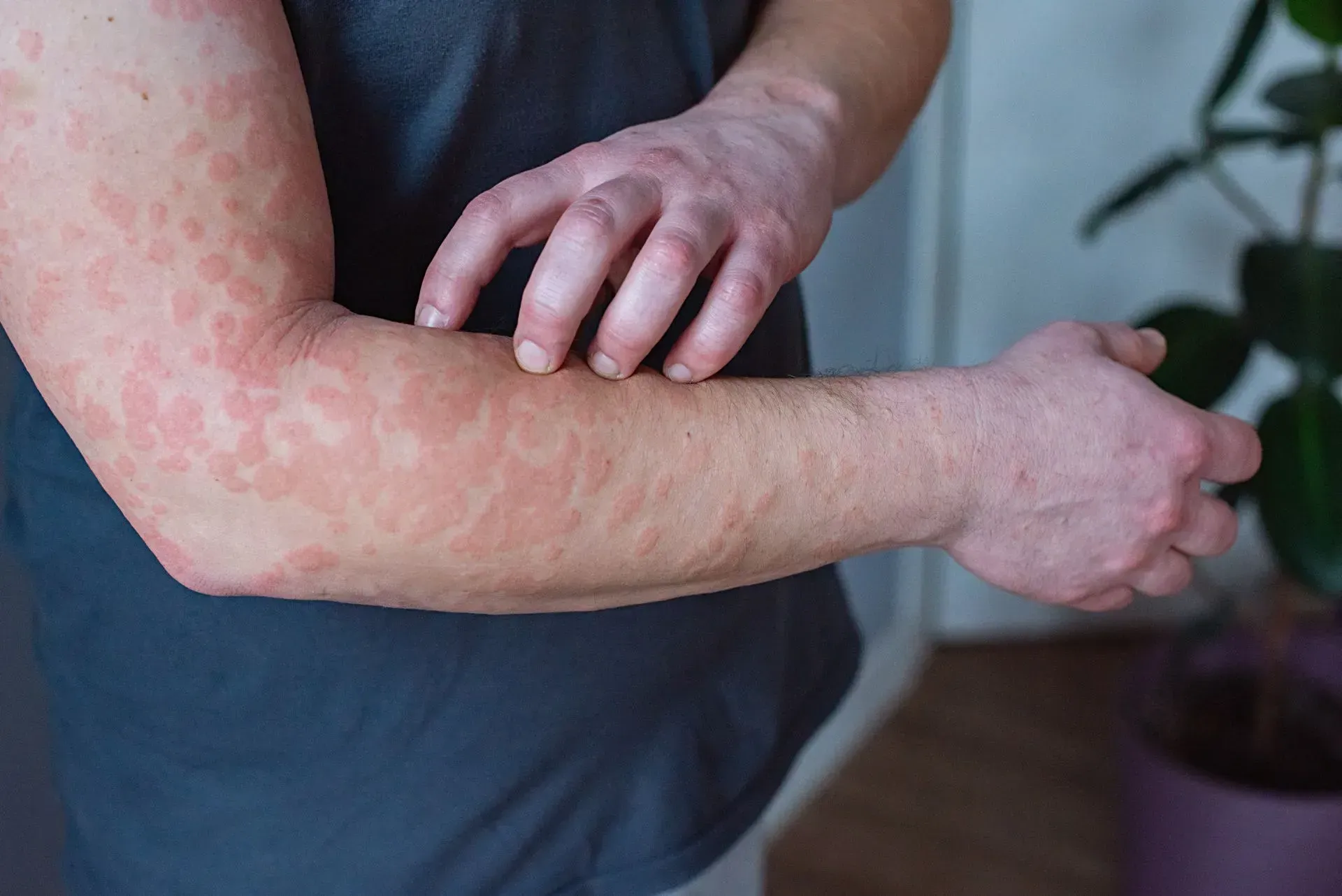 DERMATOSKIN