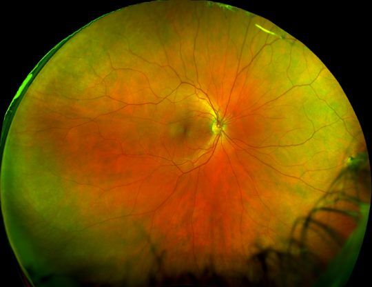 Circular retinal scan with orange-yellow and green tones, centered on the optic nerve and blood vessels.