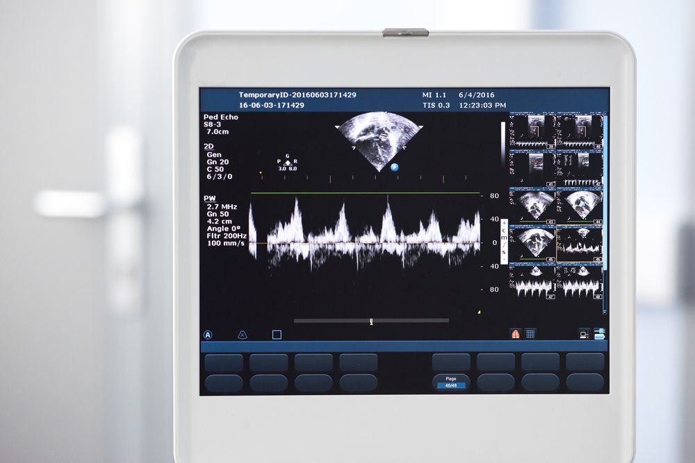Ultrasound machine screen displaying echocardiogram data.