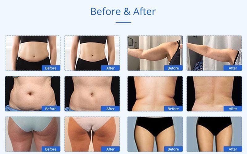 image skin studioDMK BODY ENZYME TREATMENTS!!! AND LASER LIPO + BODY CAVITATION + RADIOFREQUENCY