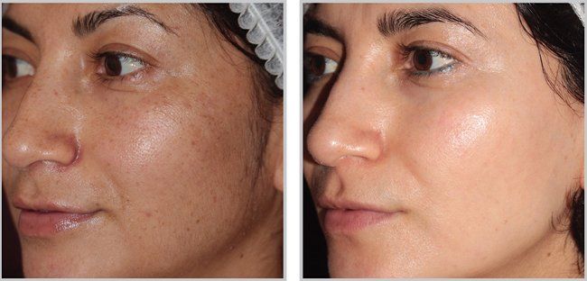 www.imageskinstudio.com day spa Before and after ipl photofacials anti aging