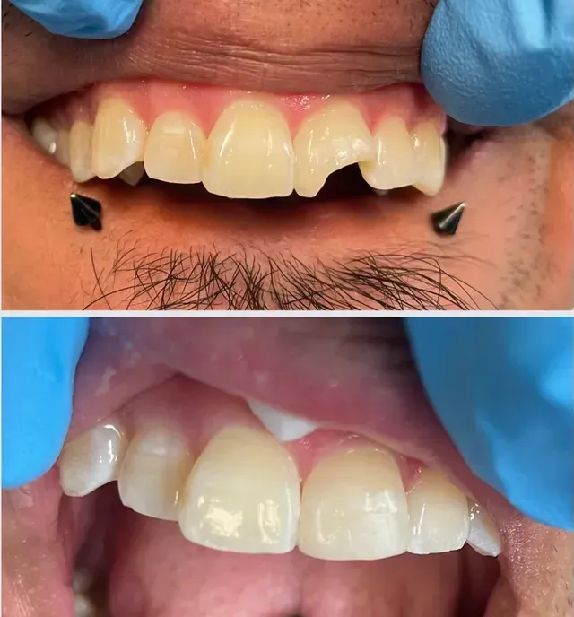 Top: Damaged teeth before dental work. Bottom: Repaired teeth, showing the dental restoration.