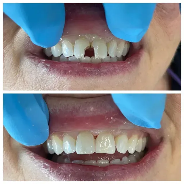 Top: Close-up of teeth with a gap. Bottom: Repaired teeth. Both shots have gloved hands and mouth.