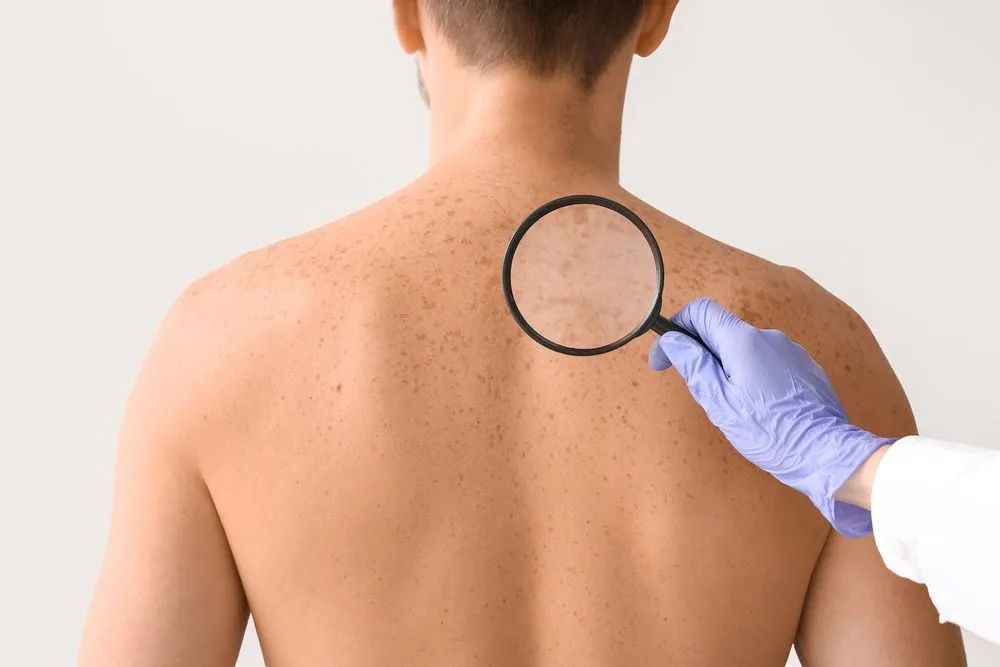 An Ongoing Skin Checks