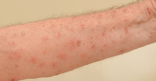 gatal karena tungau scabies