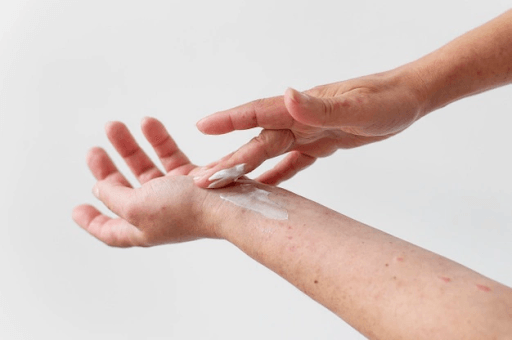tips meredakan gatal karena tungau dengan obat salep