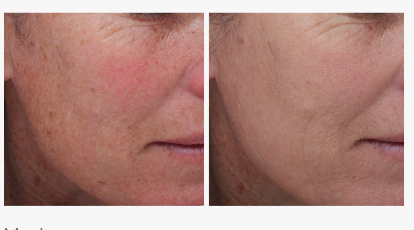 Side-by-side comparison: Before and after photos of a person's cheek showing reduced sunspots and redness after treatment.