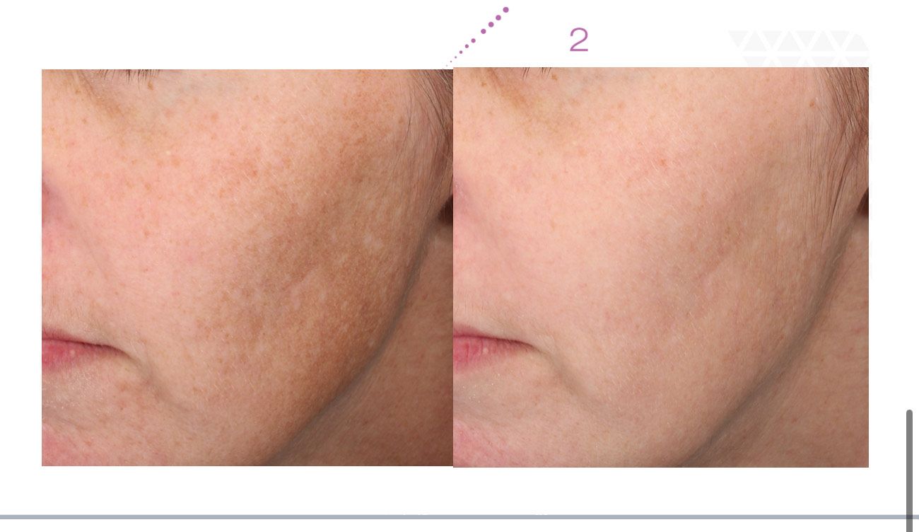 Side-by-side comparison of a face. Left side shows skin with dark spots, right side shows smoother, clearer skin.