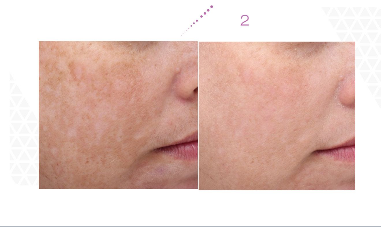 Side-by-side comparison: Face with uneven skin tone before and after treatment, showing improved clarity and tone.