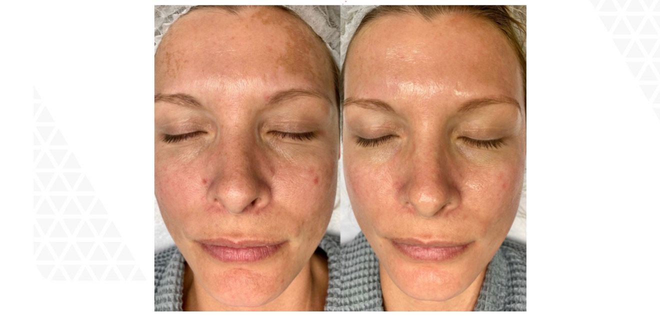 Side-by-side comparison: Face with skin discoloration before (left) and after (right) treatment.