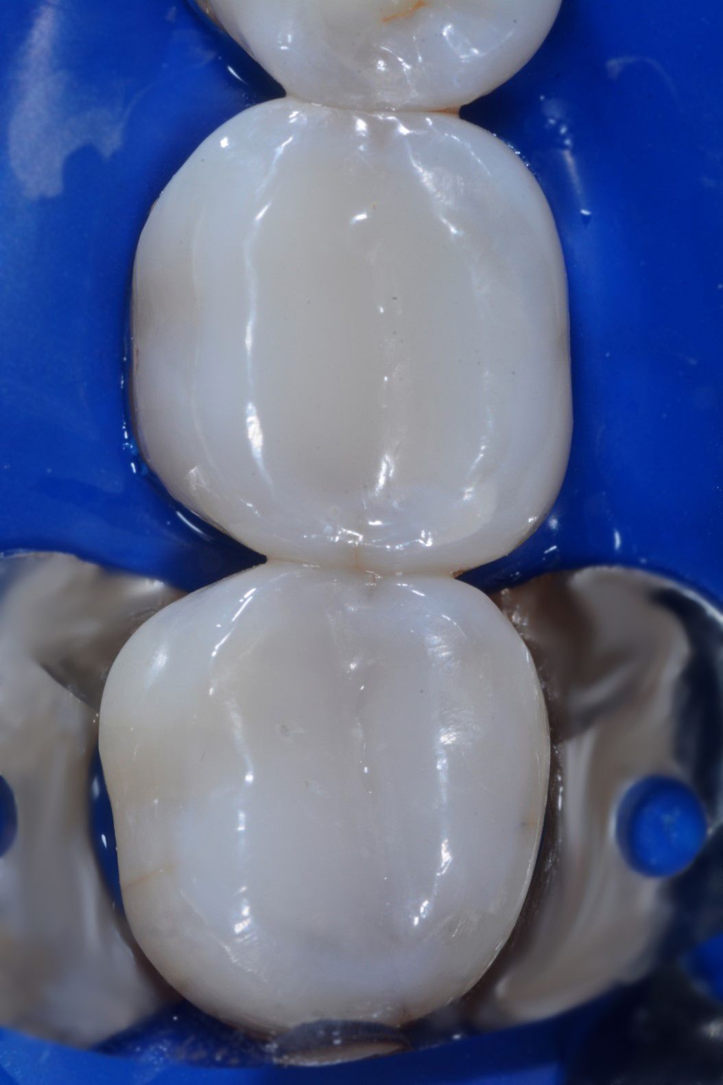 Two white dental crowns surrounded by a blue rubber dam | Ogden, UT | Pleasant Valley