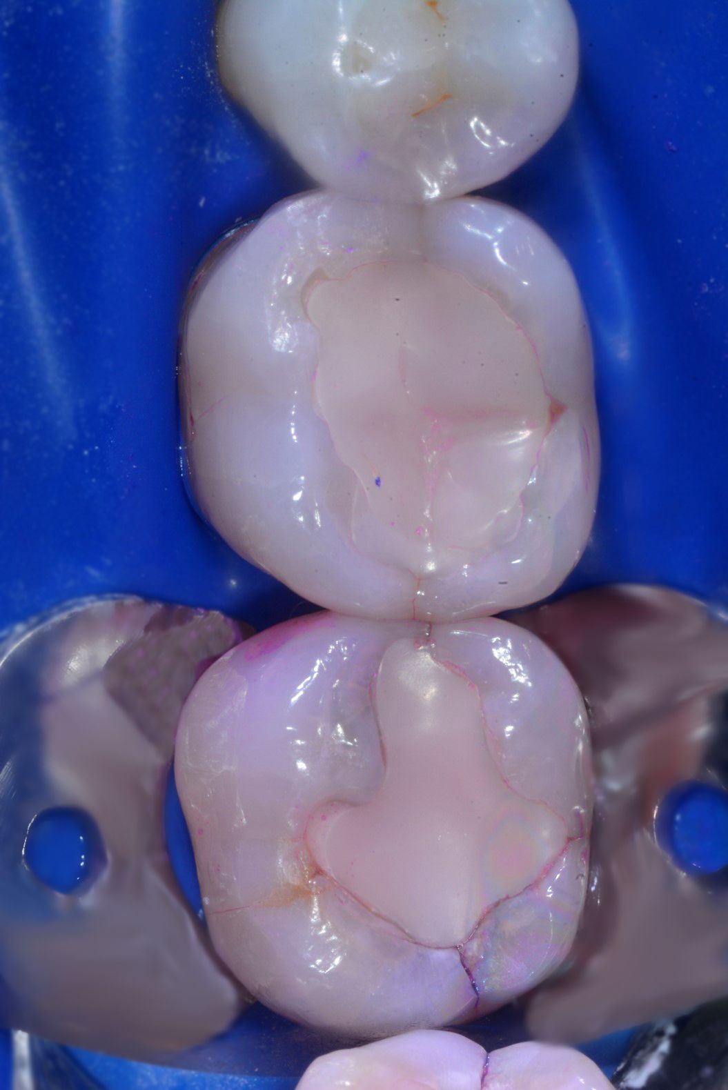 Dental view of three teeth with pink fillings and a rubber dam | Ogden, UT | Pleasant Valley