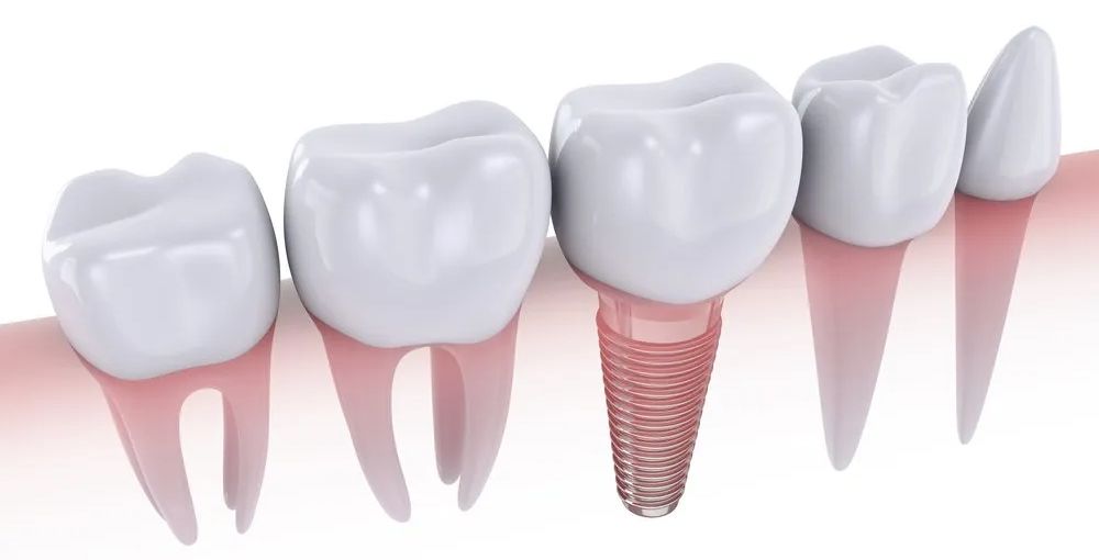 A Teeth Implant | Ogden, UT | Pleasant Valley A Teeth Implant | Ogden, UT | Pleasant Valley