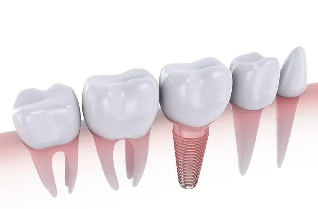 Artificial Teeth | Ogden, UT | Pleasant Valley