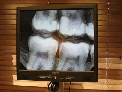 X-Ray Of A Bone On Television | Ogden, UT | Pleasant Valley