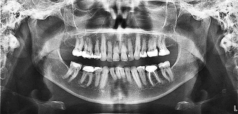 X-Ray Of A Teeth | Ogden, UT | Pleasant Valley