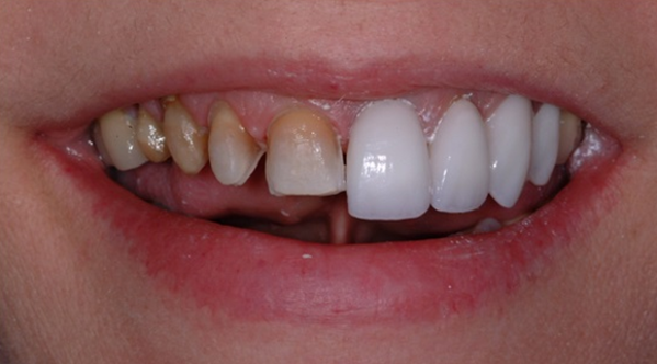 Mouth with severely discolored teeth on the left transitioning to bright white veneers on the right | Ogden, UT | Pleasant Valley Mouth with severely discolored teeth on the left transitioning to bright white veneers on the right | Ogden, UT | Pleasant Valley