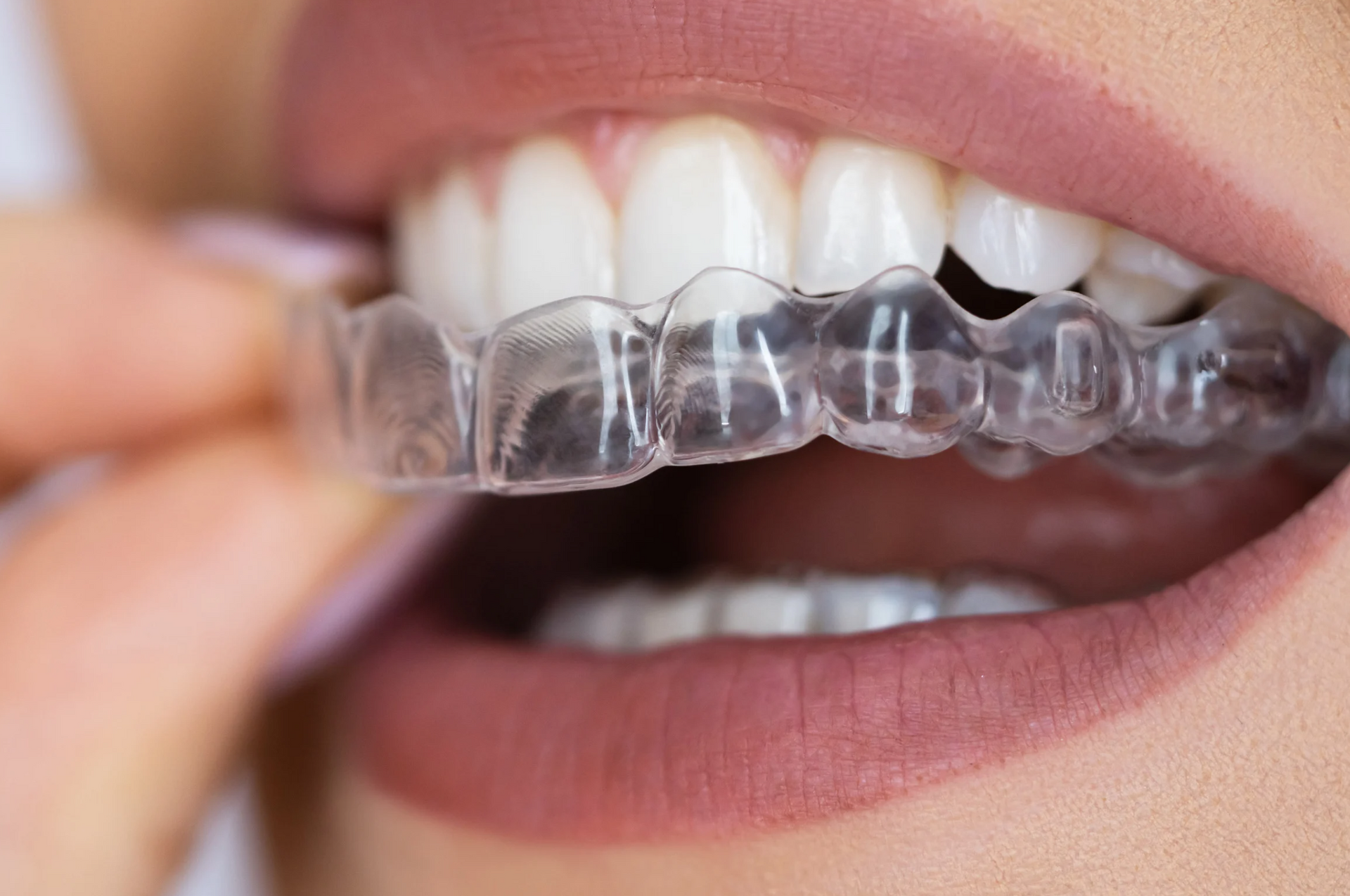 Close-up of teeth with a clear plastic aligner being removed by hand
