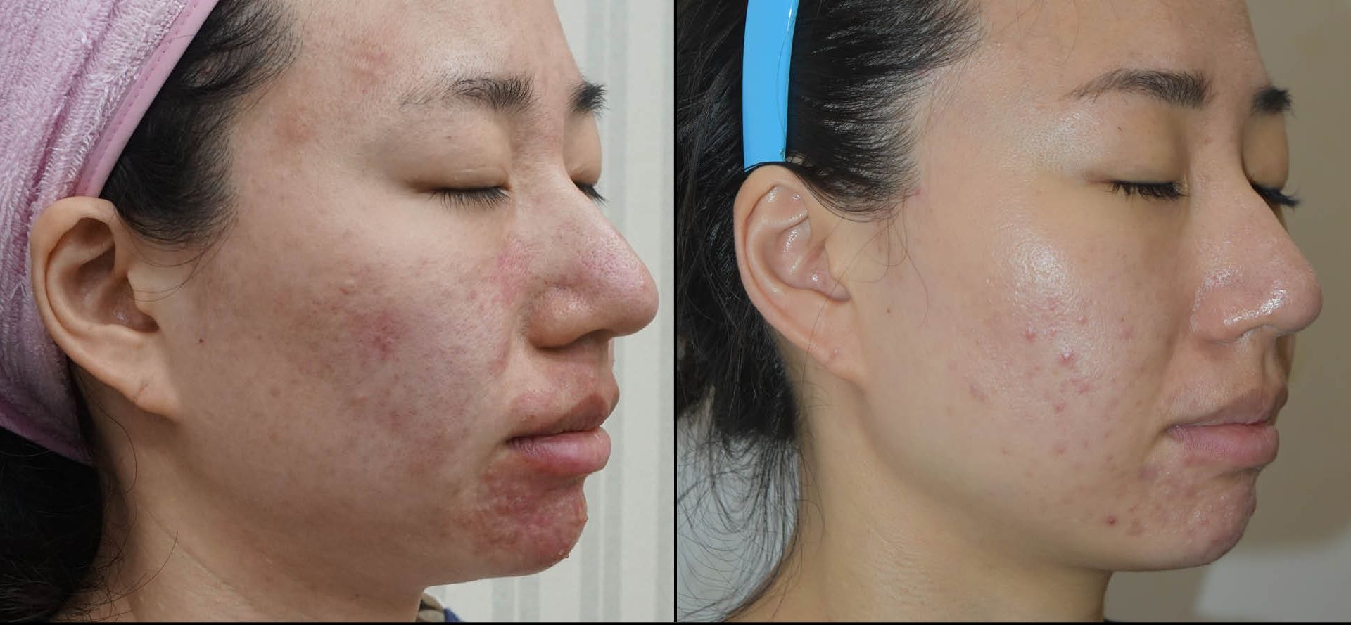 A before and after photo of a woman 's face with acne.