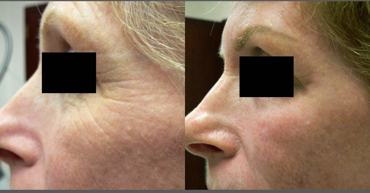 A before and after photo of a woman 's face.