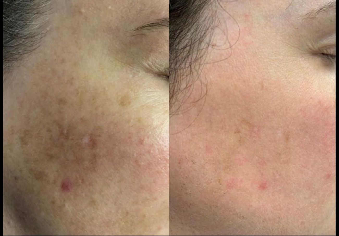 A before and after photo of a woman 's face with spots and redness.