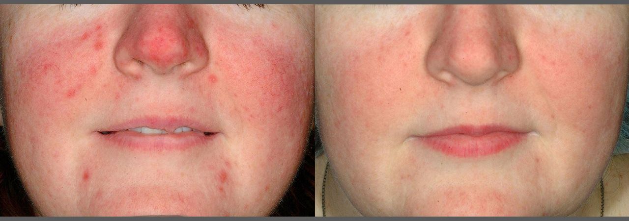 A before and after picture of a woman 's face with red spots on it.