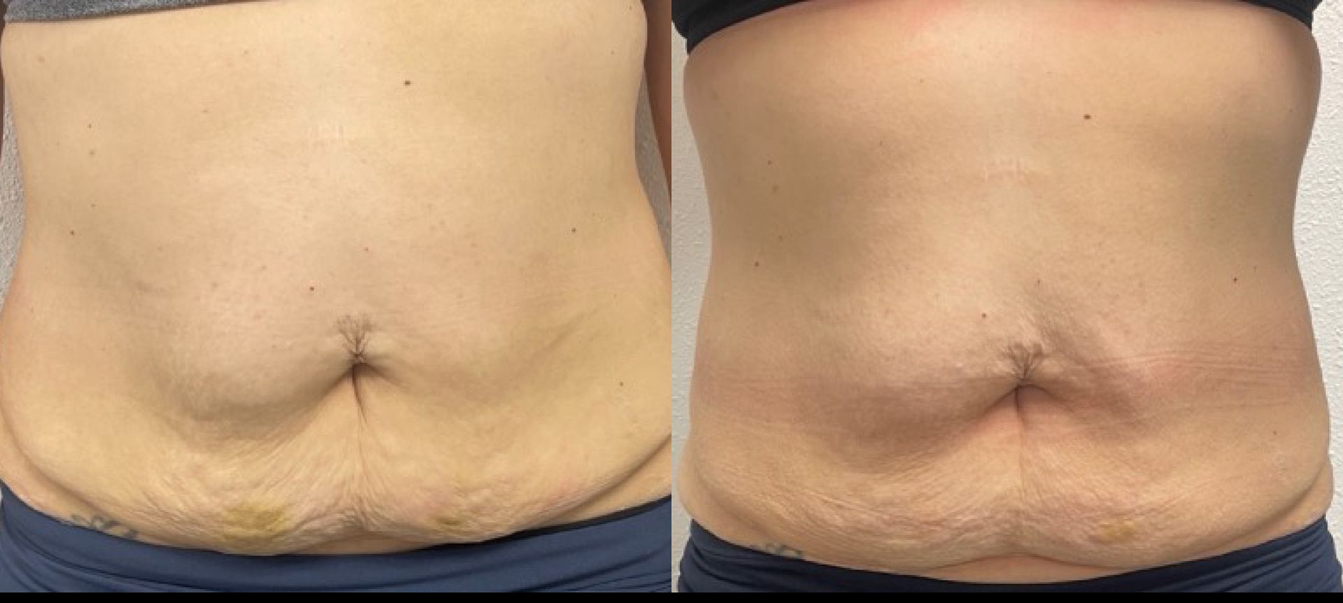 A before and after picture of a woman 's stomach.