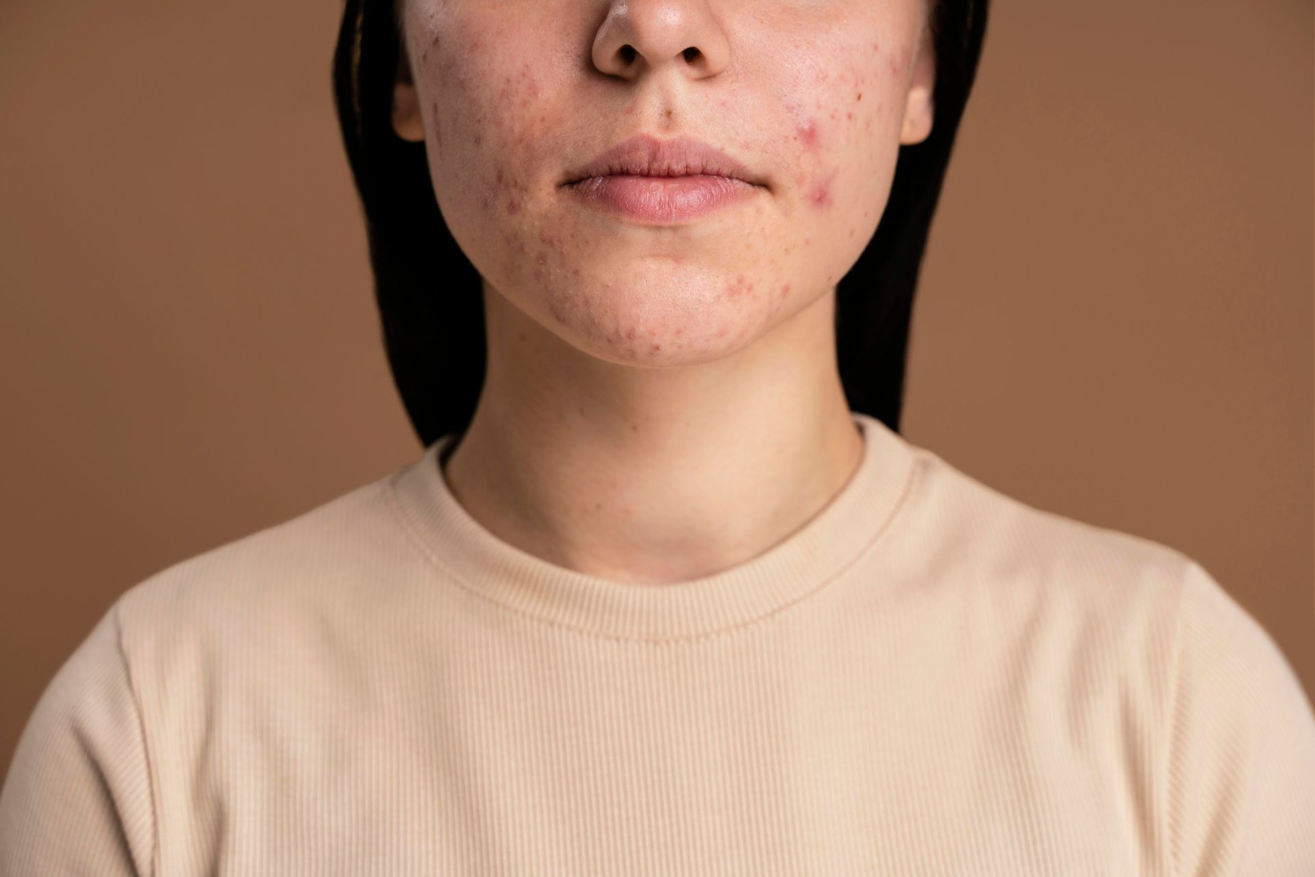 A woman with acne on her face is wearing a beige shirt.