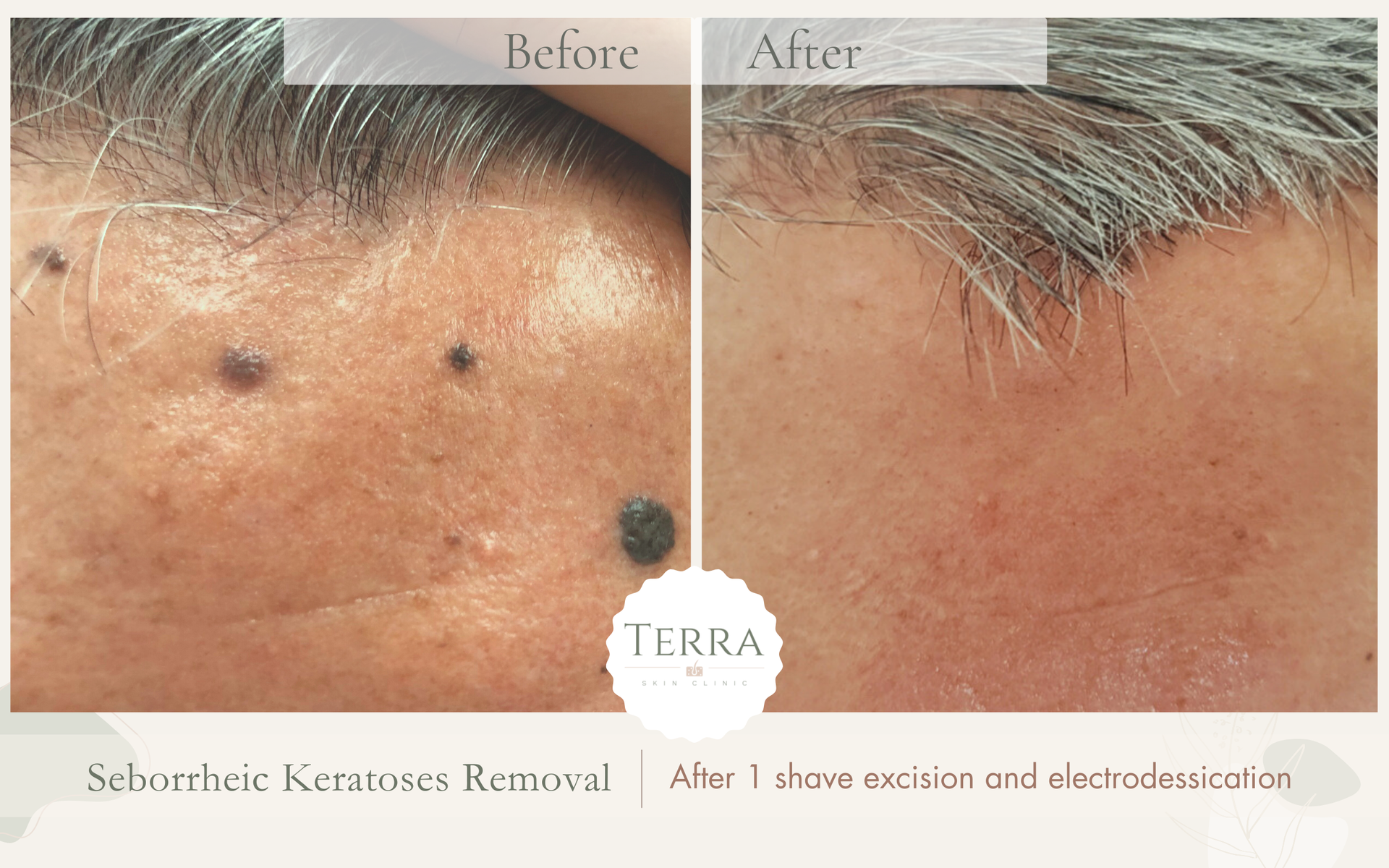 A before and after photo of a person 's face with a black spot on it.