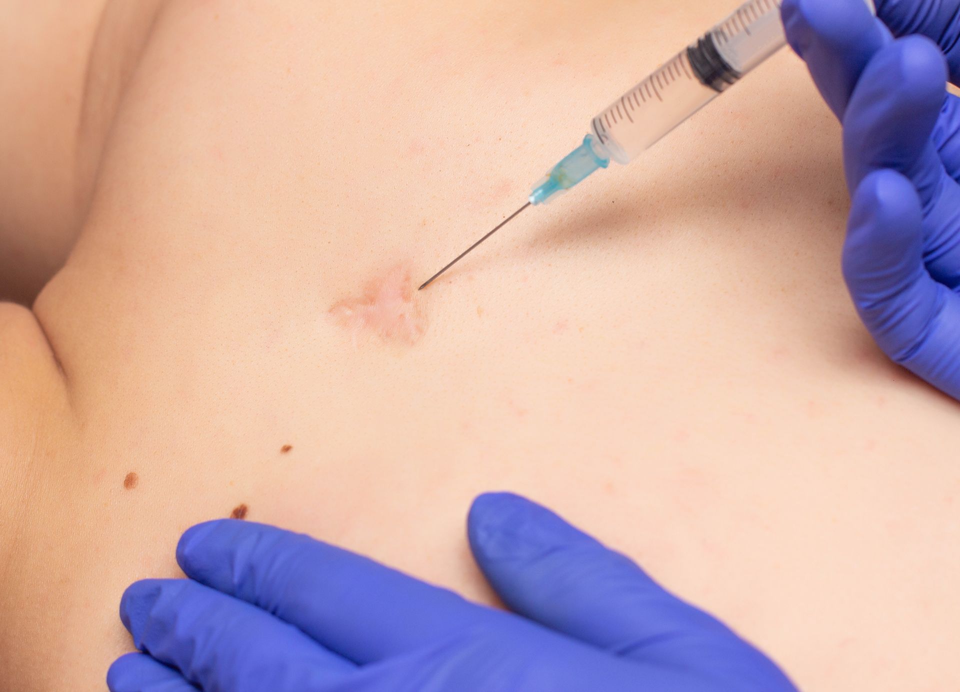A person is getting an injection in their chest with a syringe.