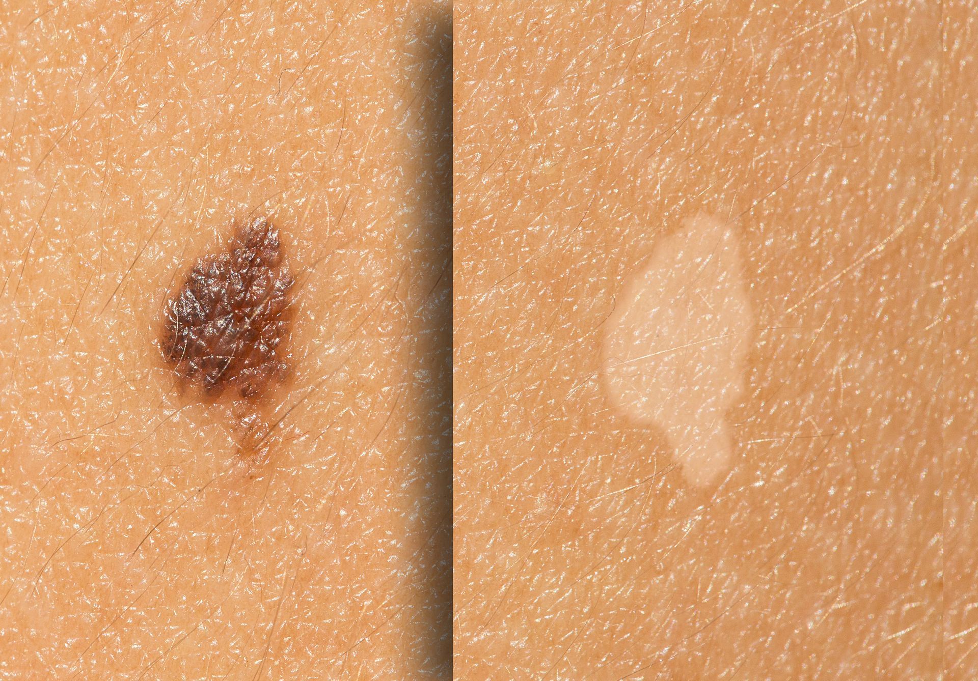 A close up of a brown spot and a white spot on a person 's skin