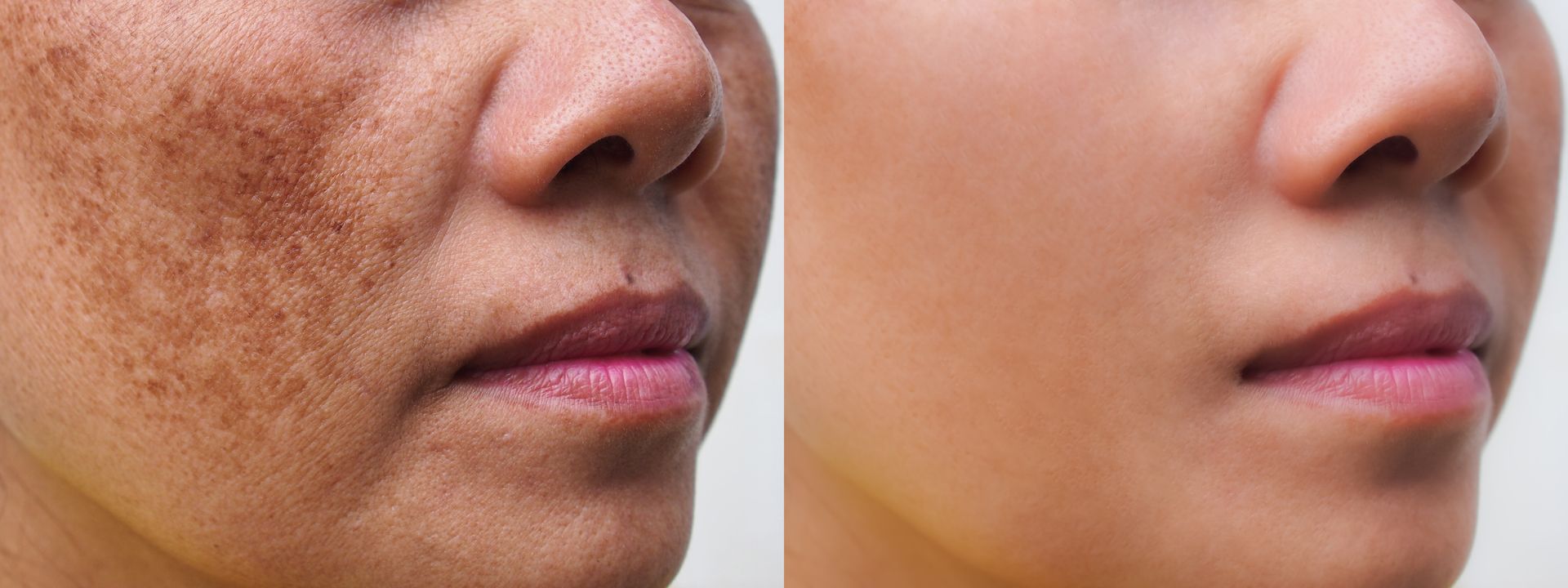 Side-by-side comparison of skin with and without hyperpigmentation, showing a nose and mouth.