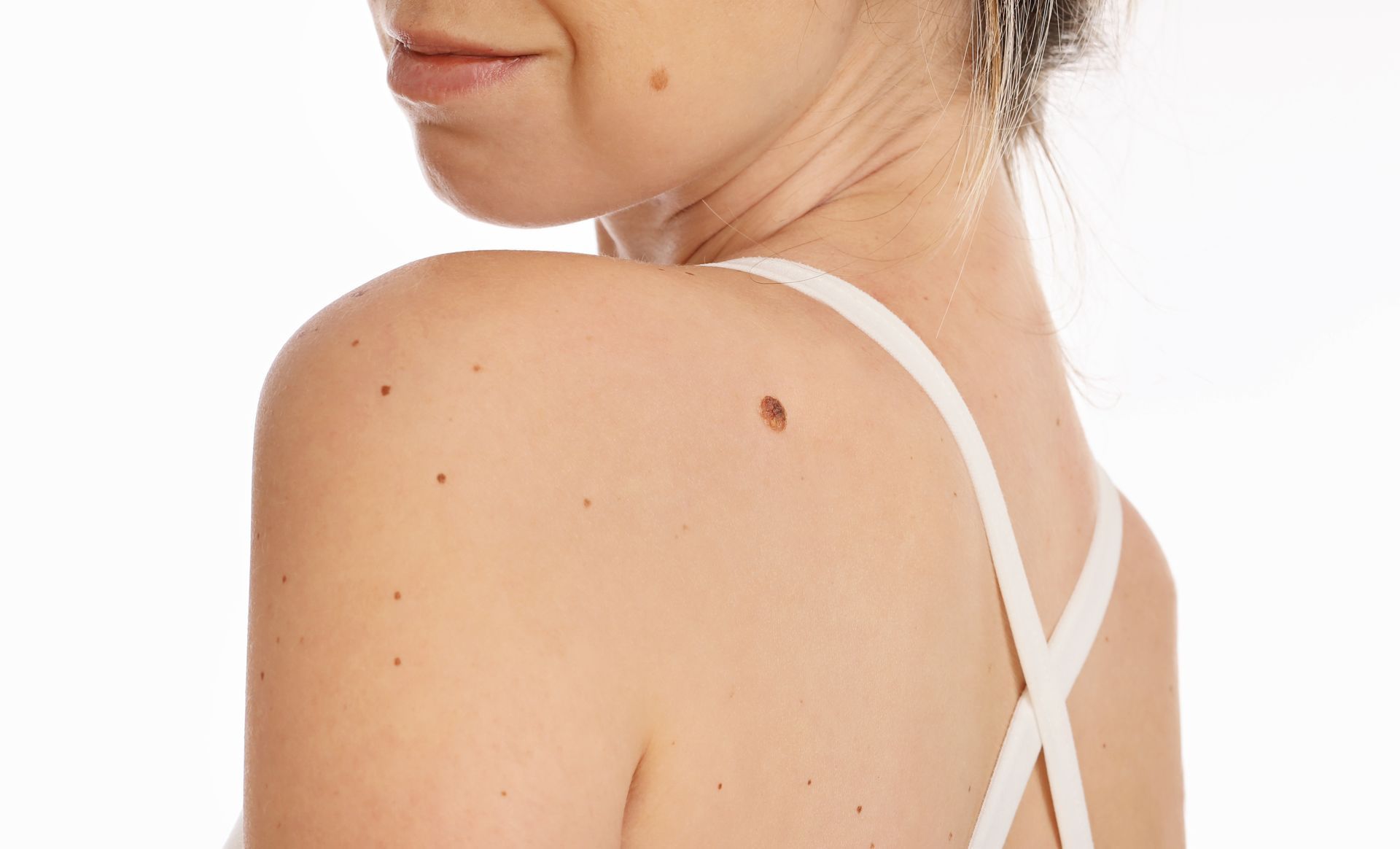 A woman with a mole on her shoulder is wearing a white bra.